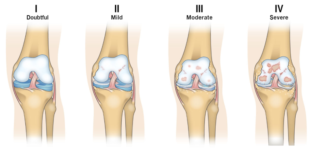 faze osteoartroze